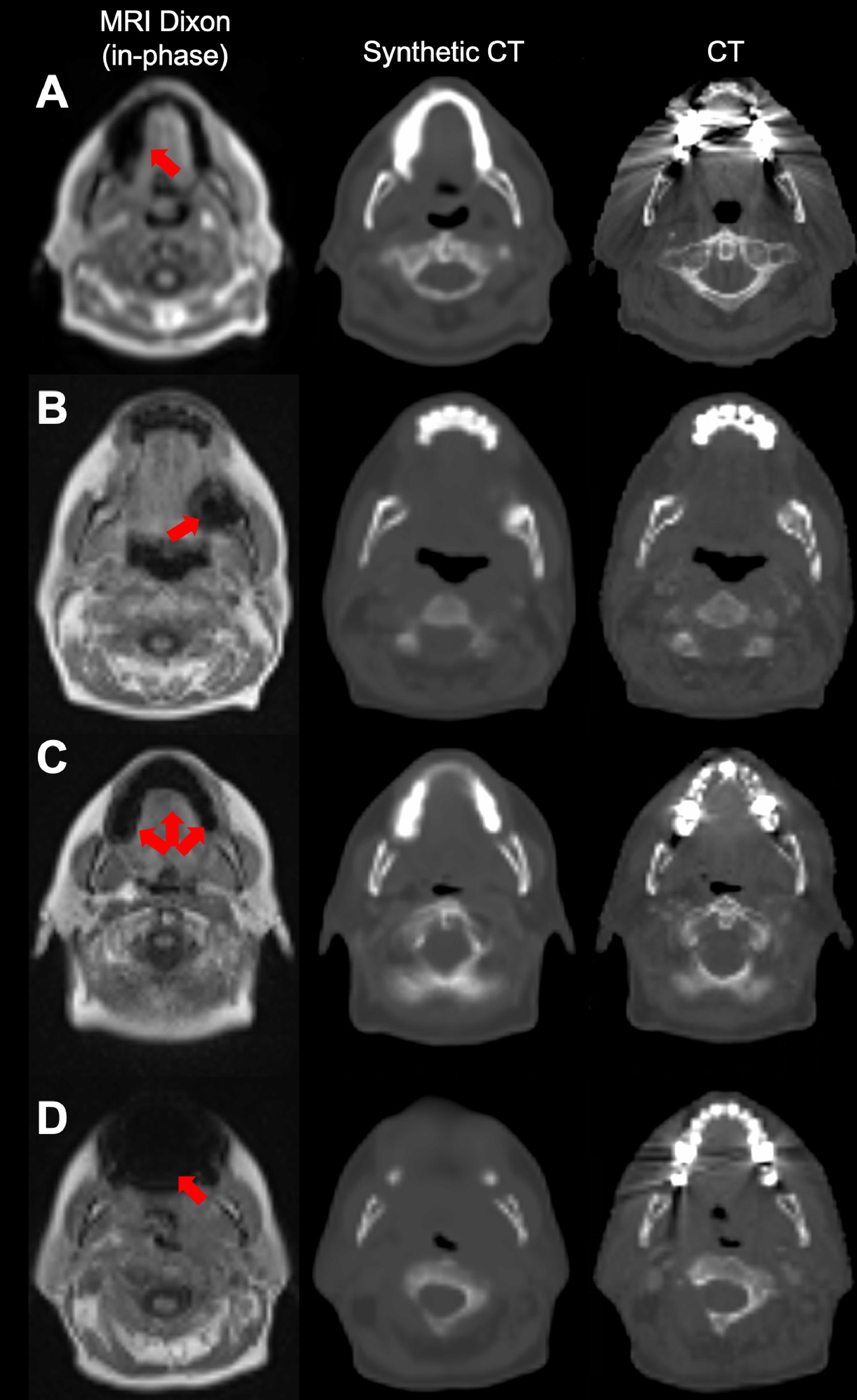 Cases illustrating the model's ability to handle metallic dental implants